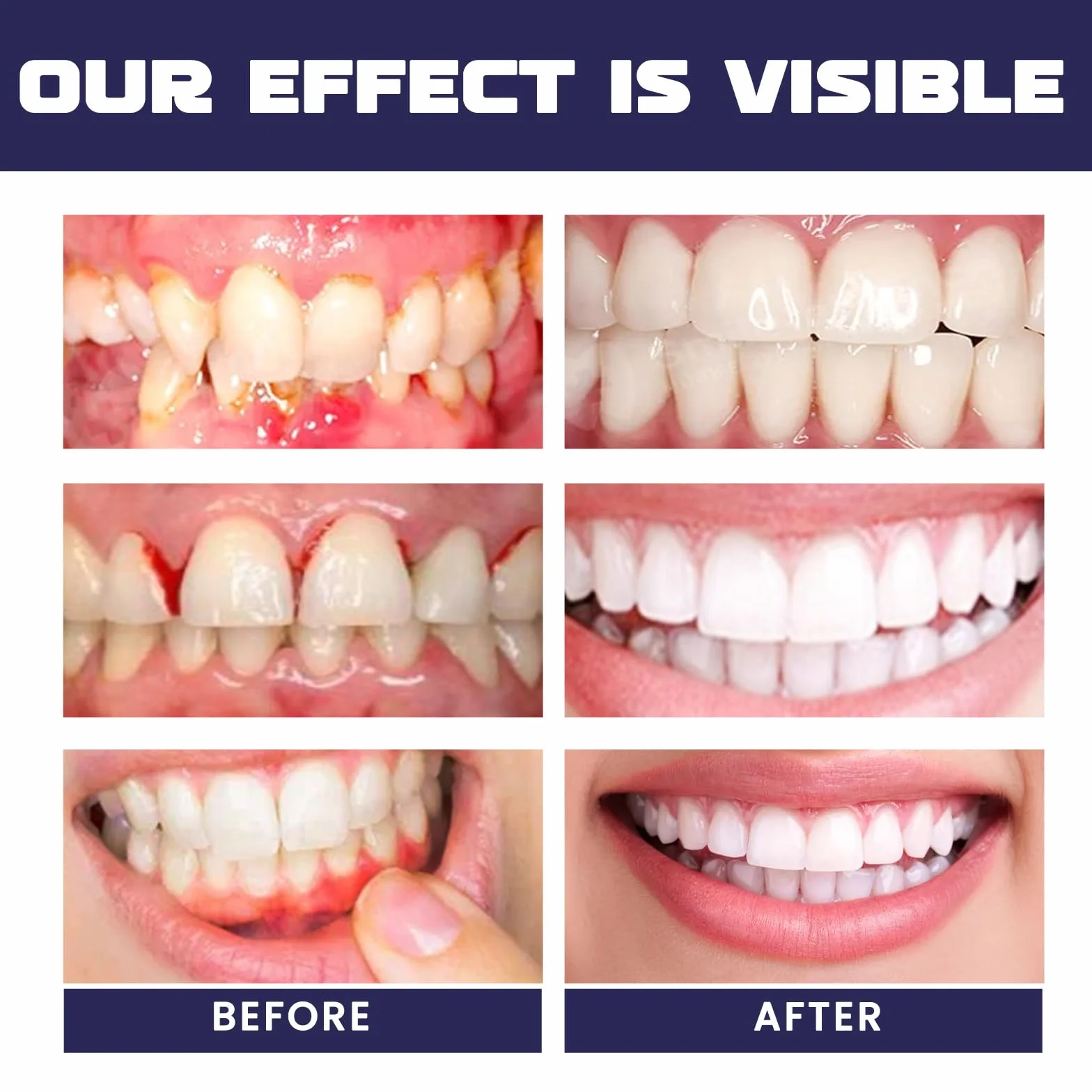 Gel Trattamento delle Gengive, Sbiancante Dentale, Recessione Gengivale