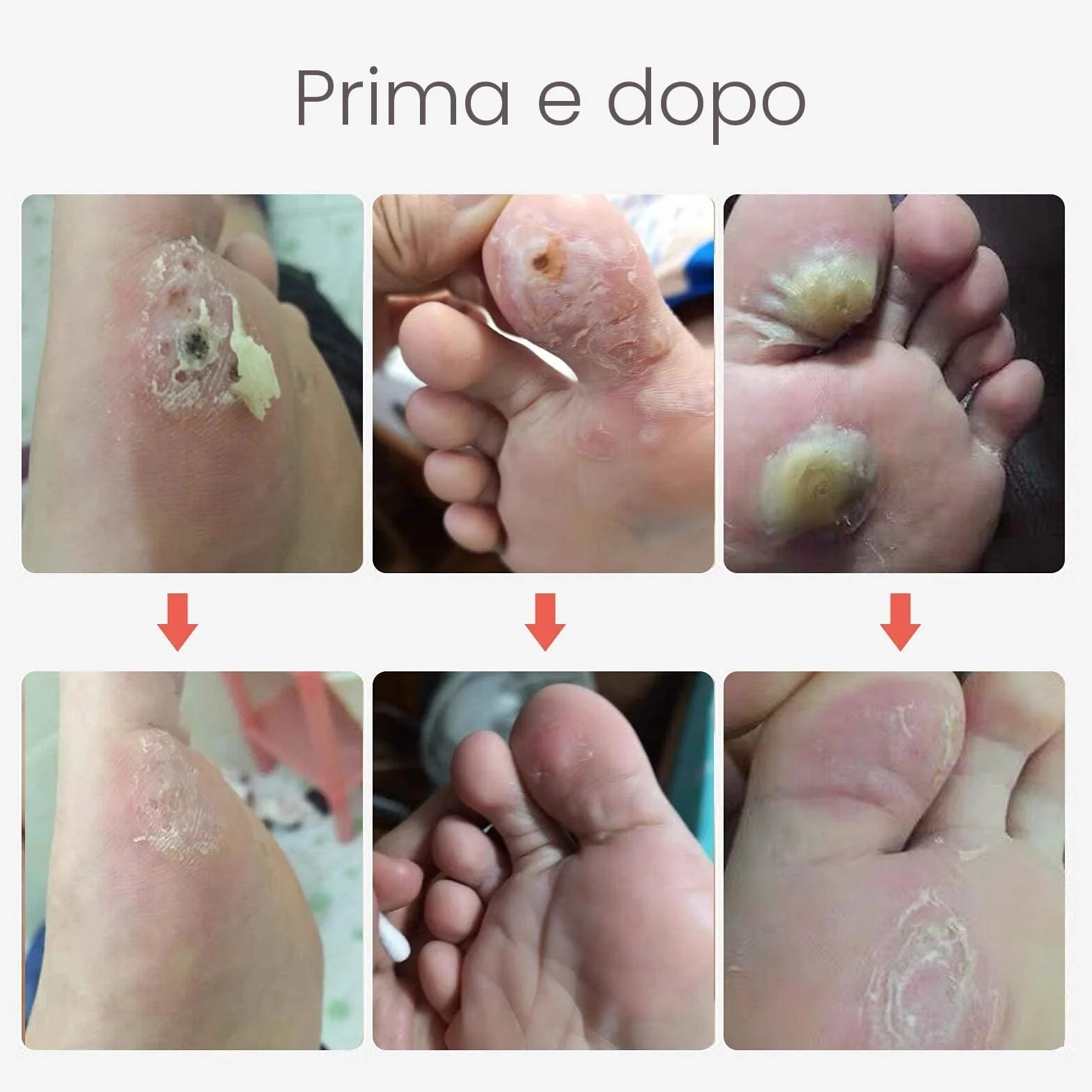 MQUPIN Callus Remover, rimozione calli per piedi, 24 pezzi