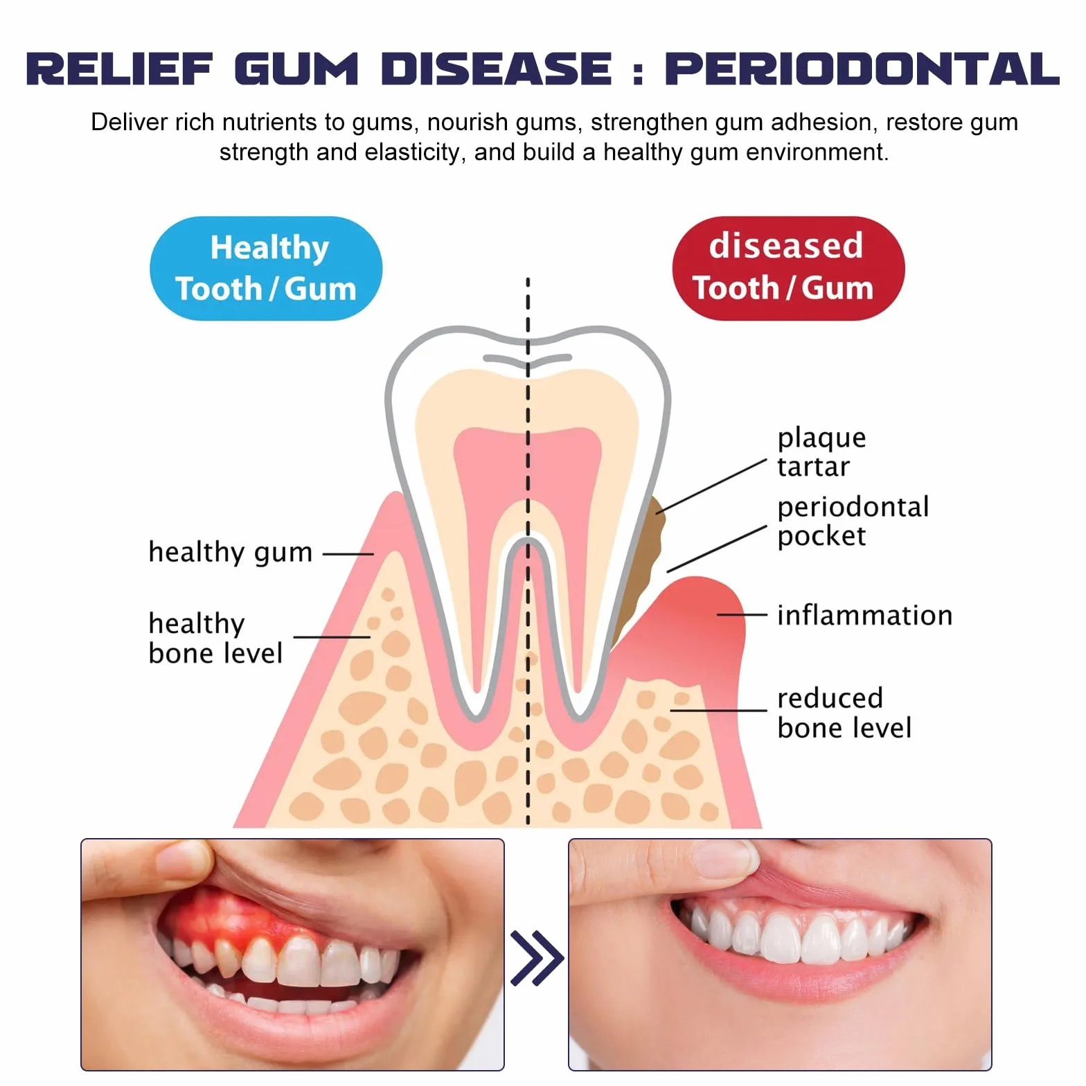Gel Trattamento delle Gengive, Sbiancante Dentale, Recessione Gengivale