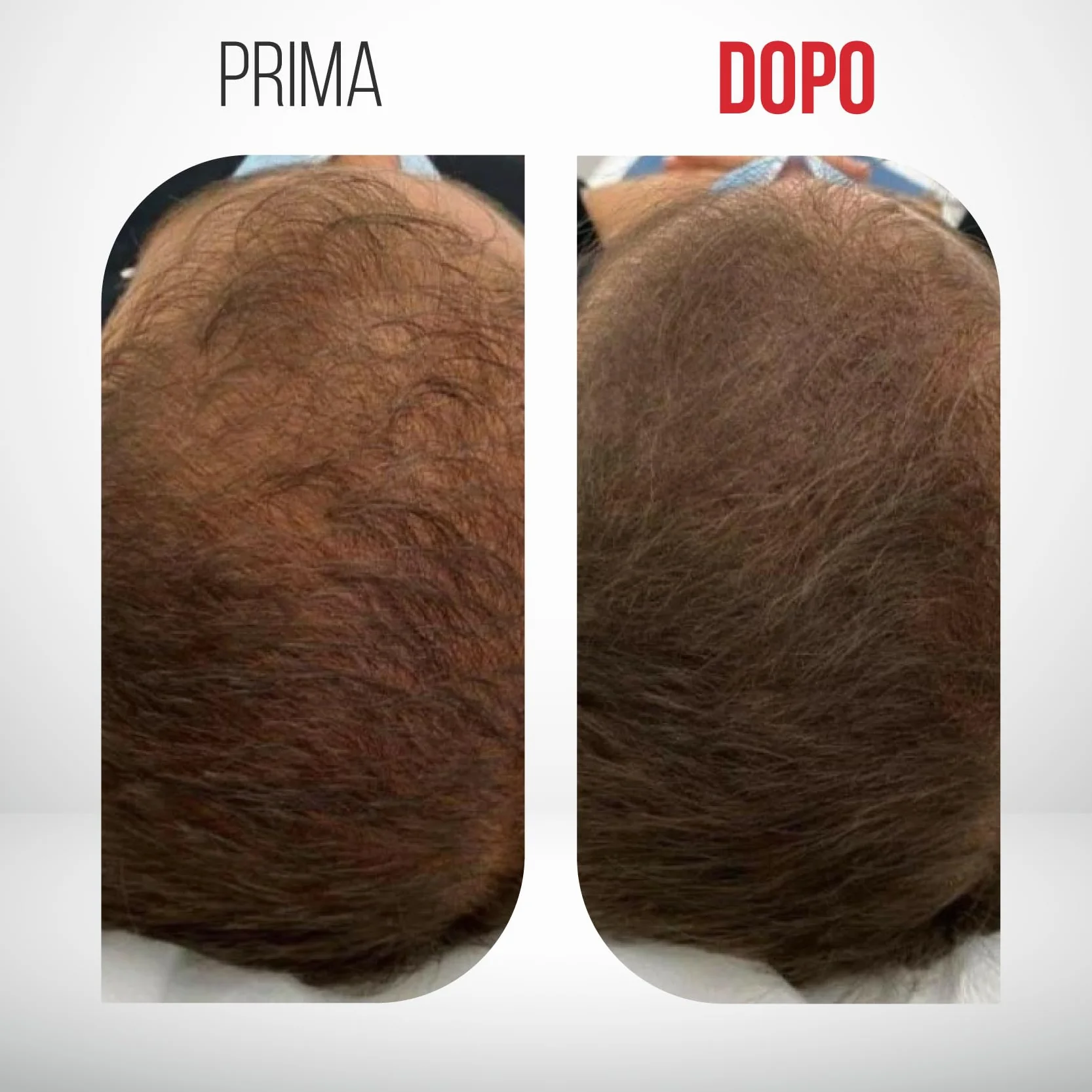Restax 30+30 softgel per alopecia androgenetica maschile, antiandrogeno, caduta capelli, ricrescita, serenoa repens