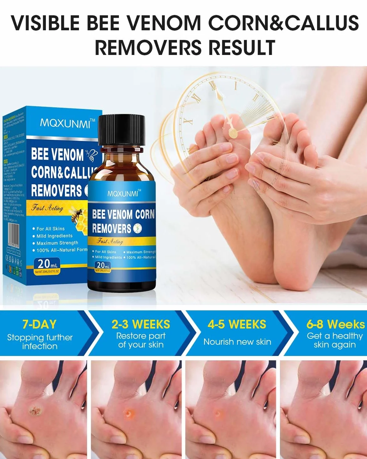 Bee Venom Callus Remover 20 ml - Rapid Action Liquid for Feet, Adults, Runners