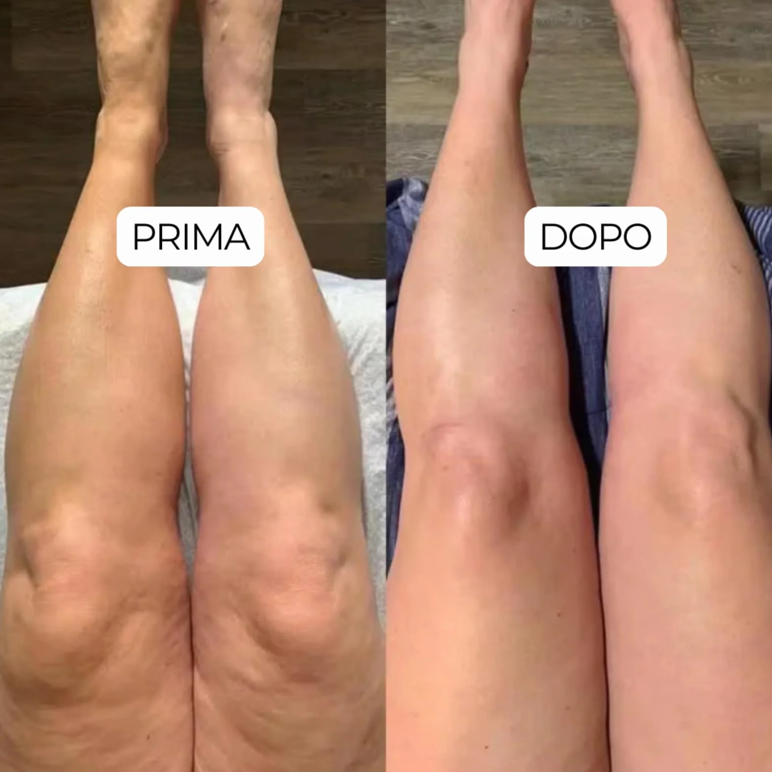 Linfia Drenaggio Linfatico Gocce, Gocce per Drenaggio Linfatico, Miscela di Erbe Naturali