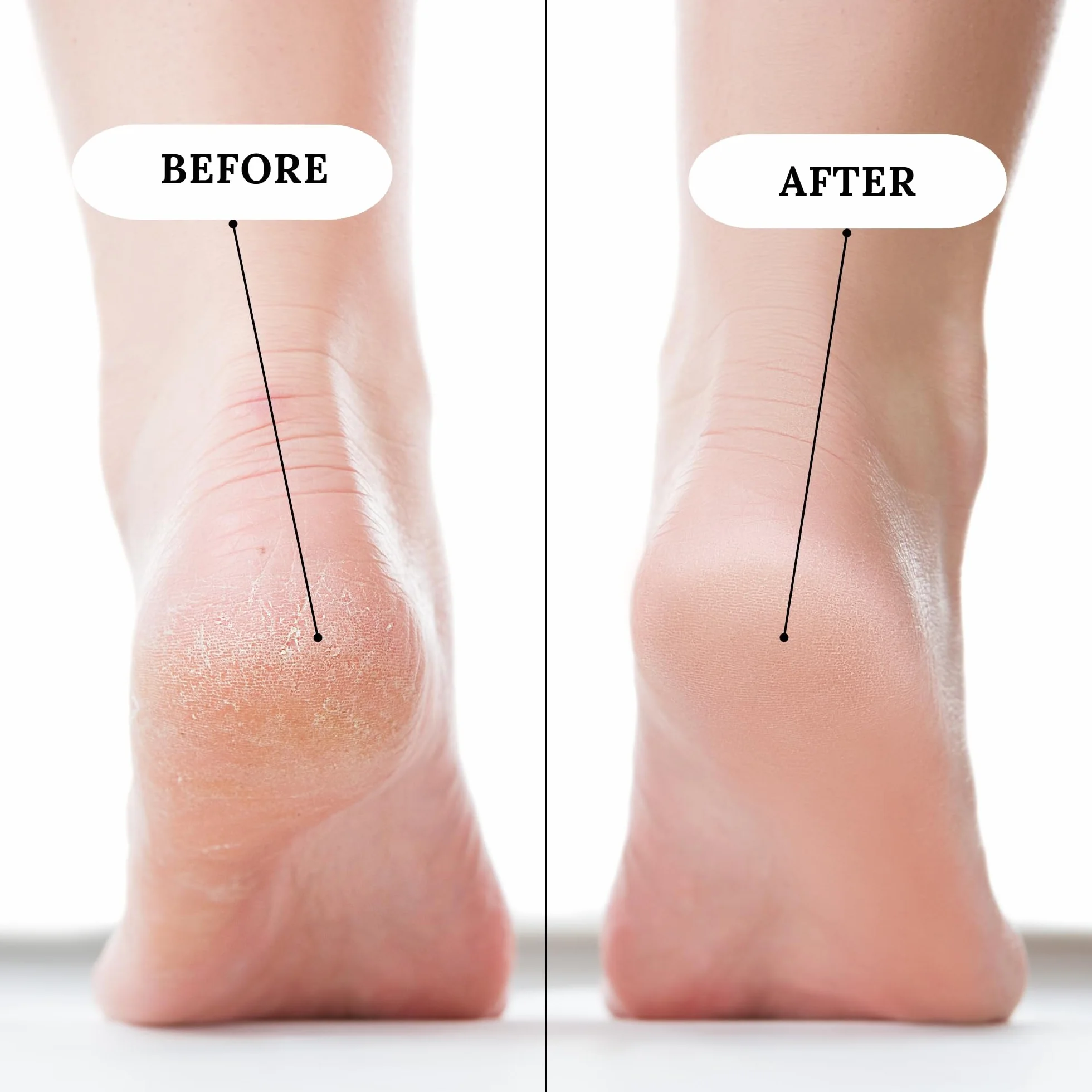 SNB Professional Callus Removal Spray 110 ml con urea, olio di lavanda, glicerina, eucalipto, camomilla, composizione naturale al 91%