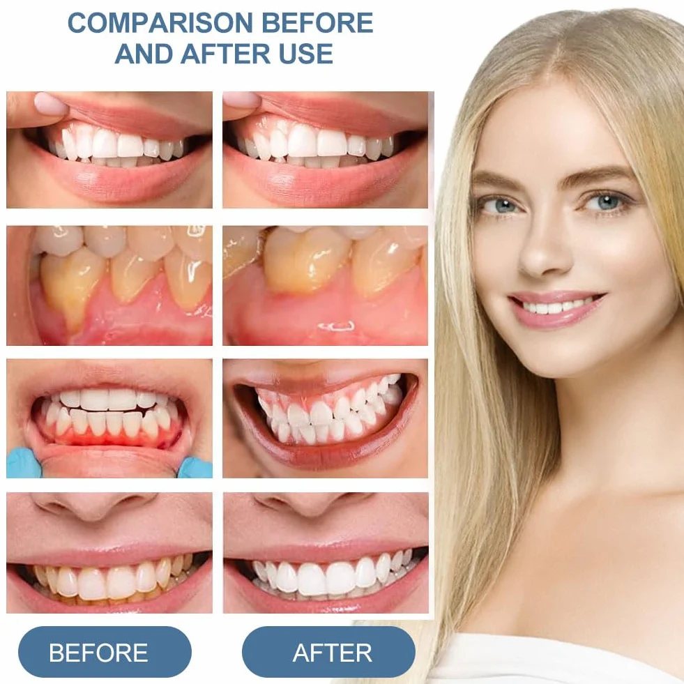 Gengivo Terapia Gel Trattamento Cura Gengive Ricrescita
