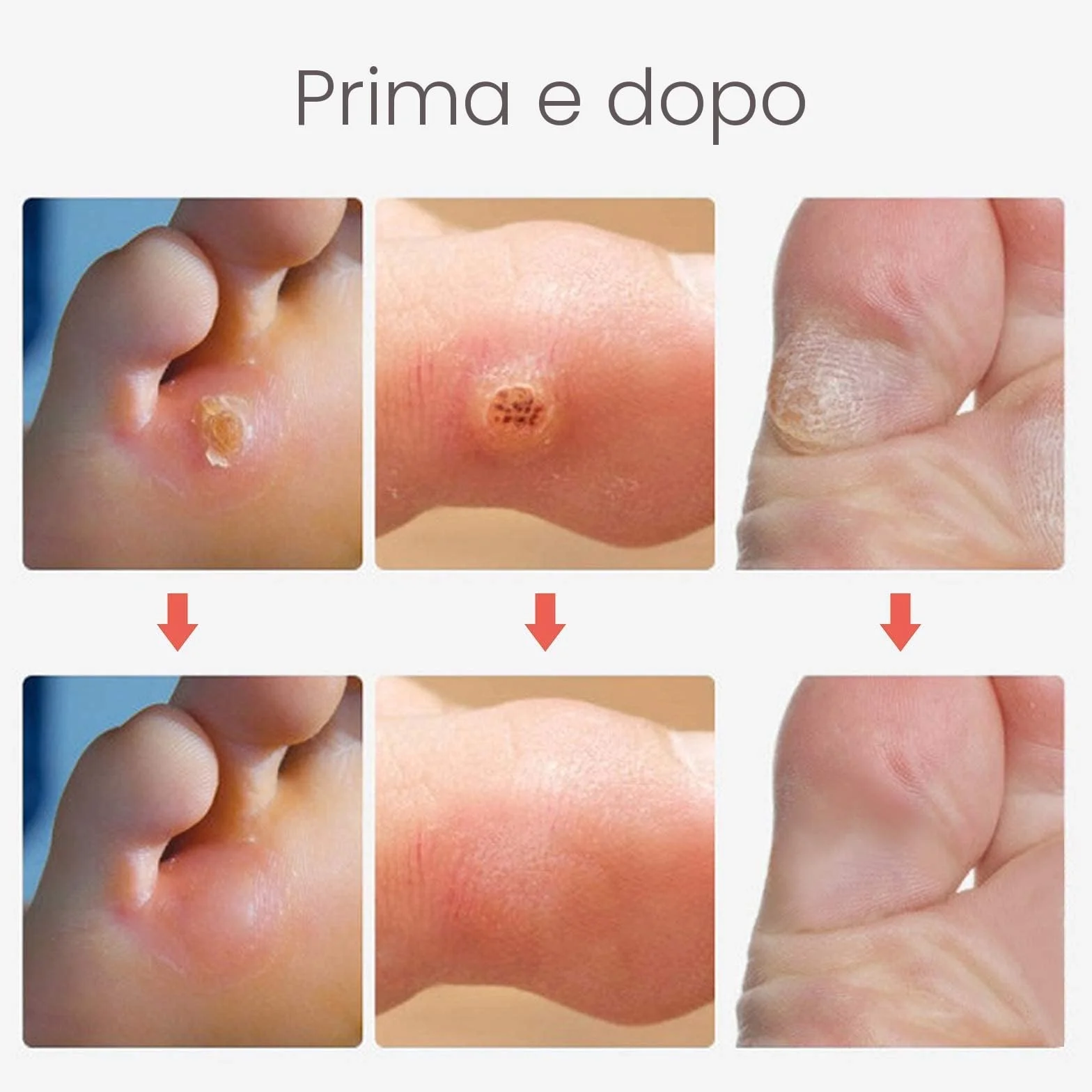 MQUPIN Callus Remover, rimozione calli per piedi, 24 pezzi