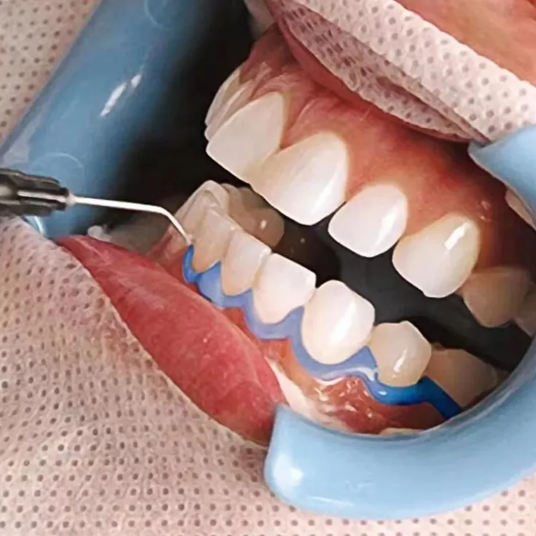 Sbiancamento dentale professionale 6 punte gel protettivo gengivale 3 ml siringa dentale