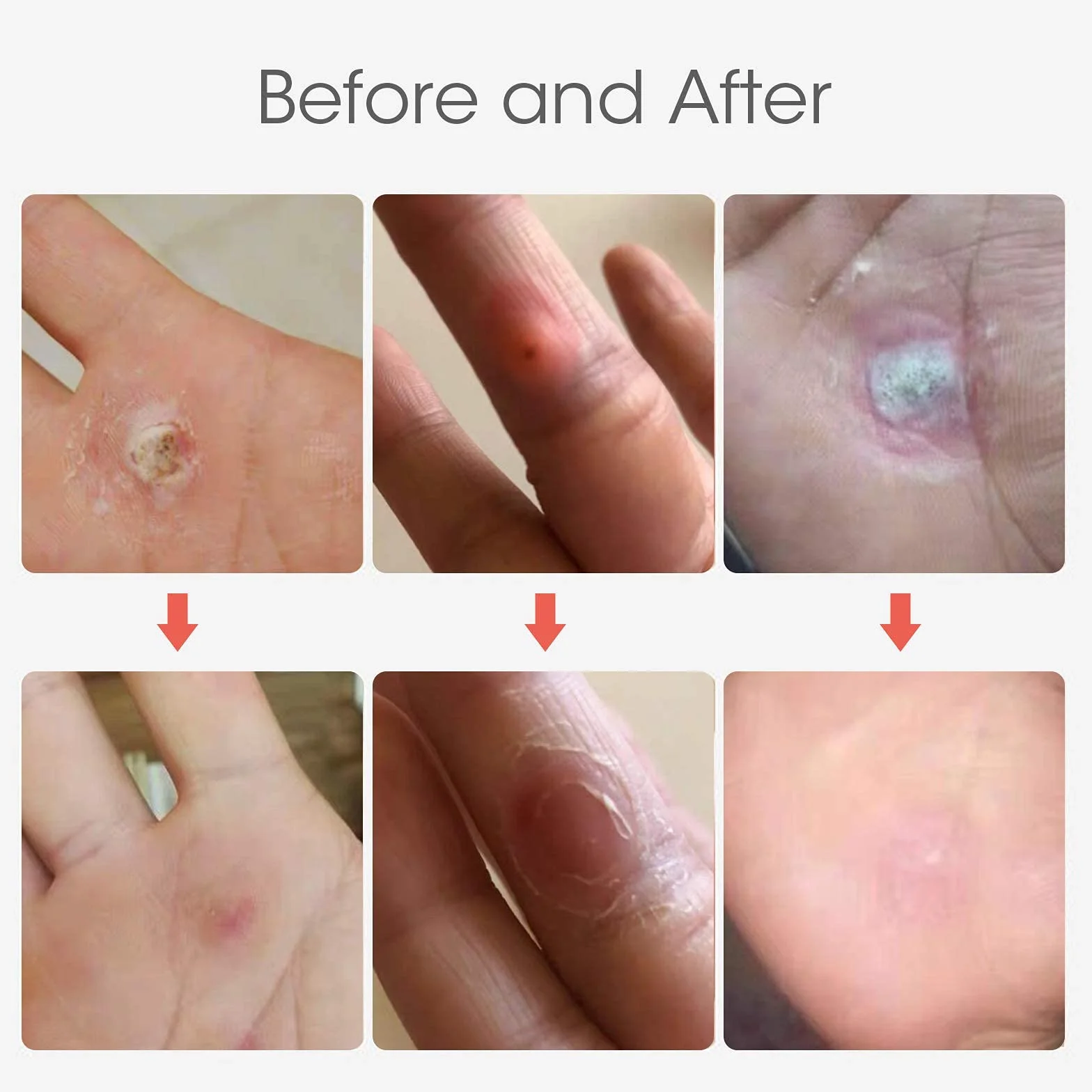 MQUPIN Callus Remover, rimozione calli per piedi, 24 pezzi