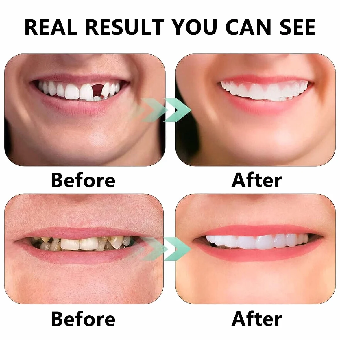 Denti Finti Temporanei Clip Superiore e Inferiore, Protesi Cosmetica in Silicone per Coprire Denti Mancanti